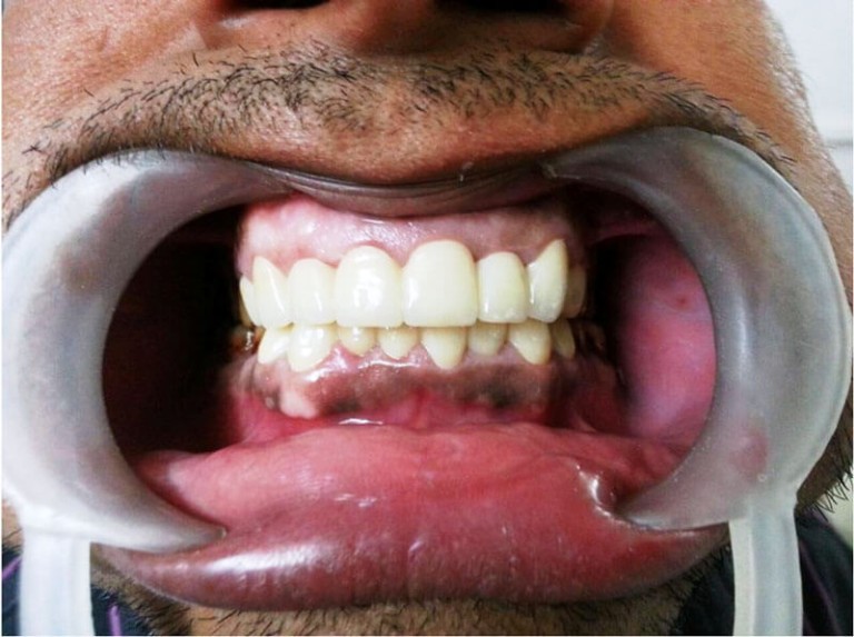 Full mouth pfm