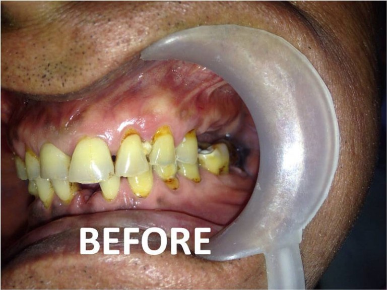 Full Mouth Zirconia