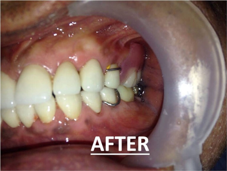 Full Mouth Zirconia