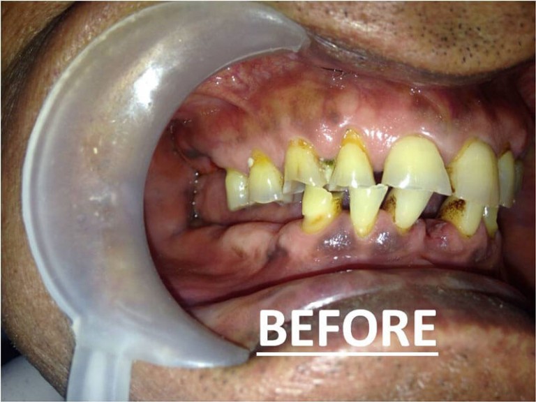 Full Mouth Zirconia