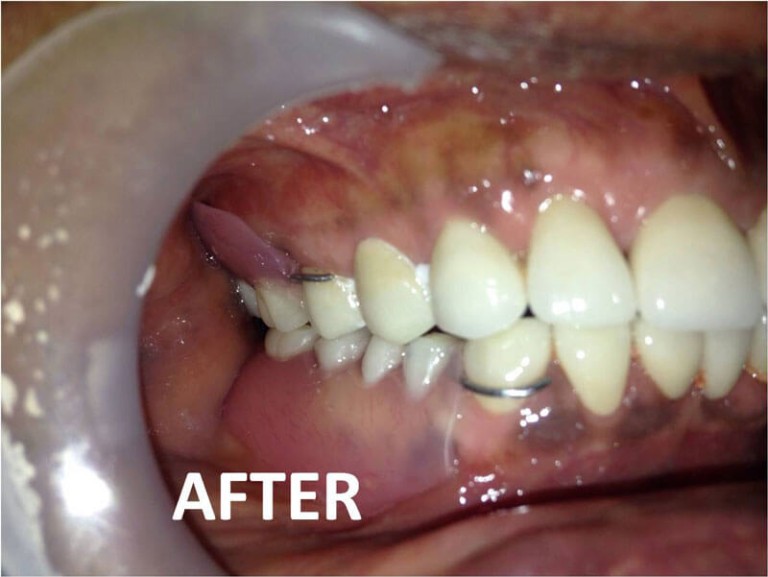 Full Mouth Zirconia
