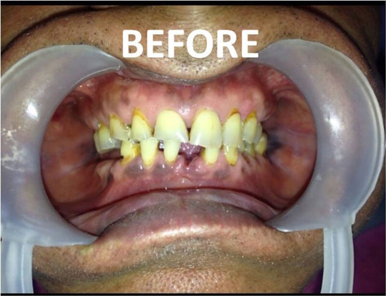 Full Mouth Zirconia