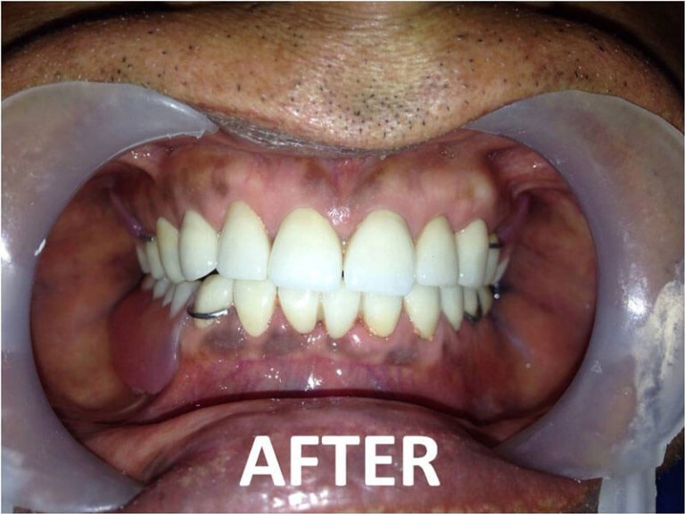 Full Mouth Zirconia