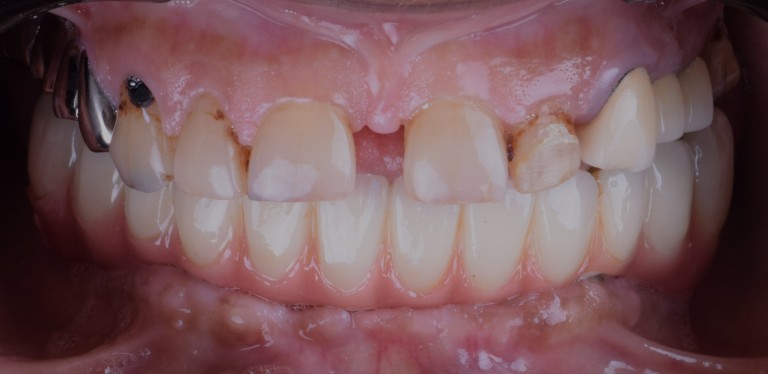 Lower Full Mouth