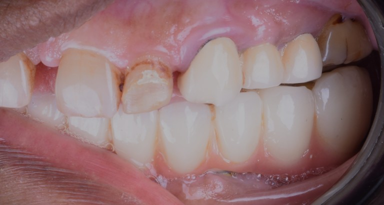 Lower Full Mouth