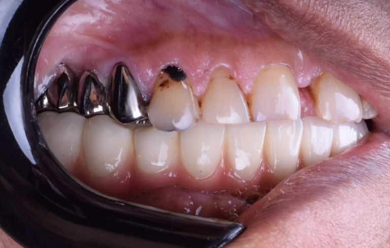 Lower Full Mouth