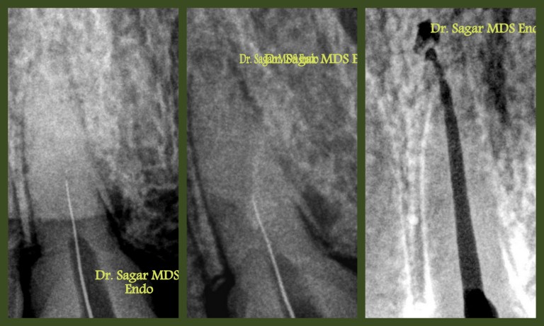calcified root canal treatment