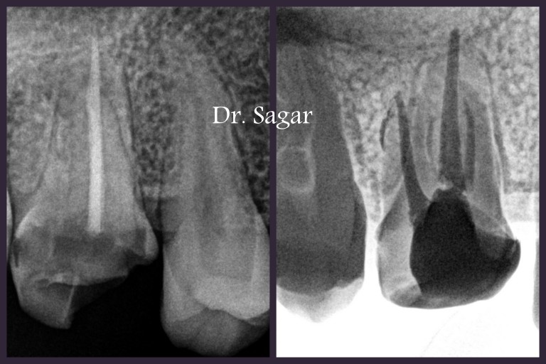 re root canal treatment