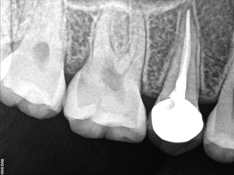 root canal treatment