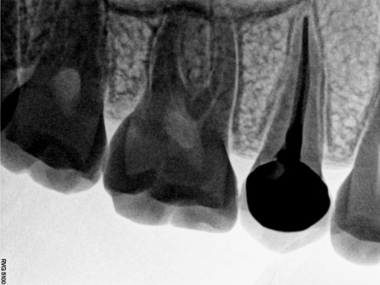 root canal treatment