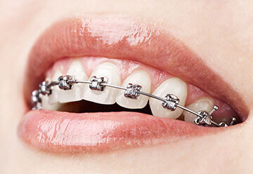 Braces