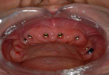 Single Tooth Implant