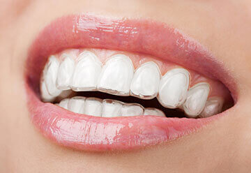 Clear Braces