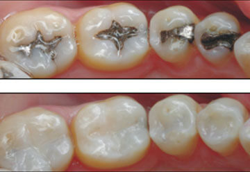 Cosmetic Tooth Filling