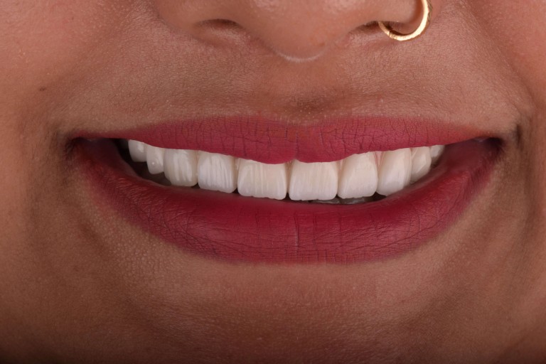 Full Mouth Inhabilitation