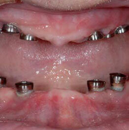 Full Mouth Implant