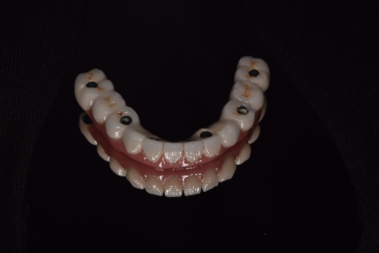Full Mouth Inhabilitation
