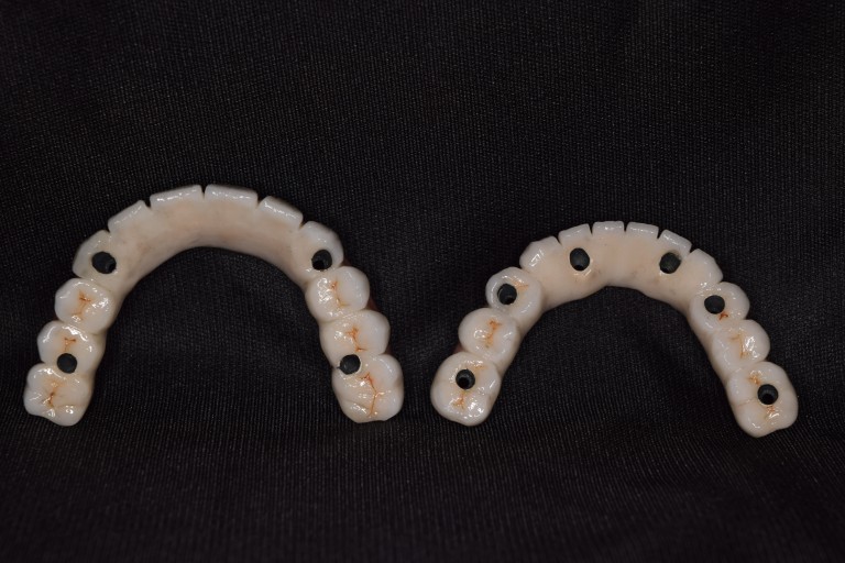 Full Mouth Inhabilitation