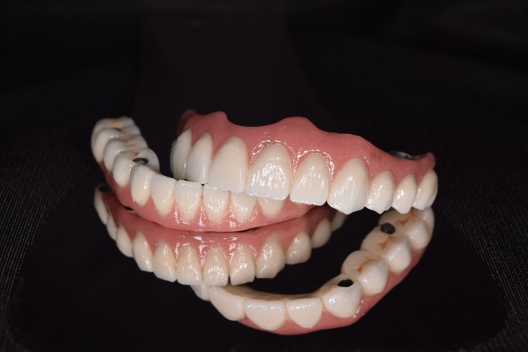 Full Mouth Inhabilitation