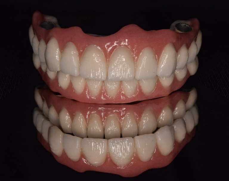 Full Mouth Inhabilitation