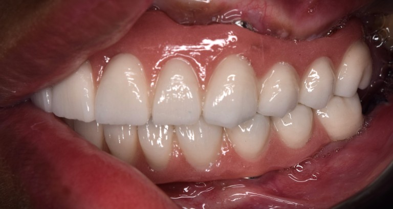 Full Mouth Inhabilitation
