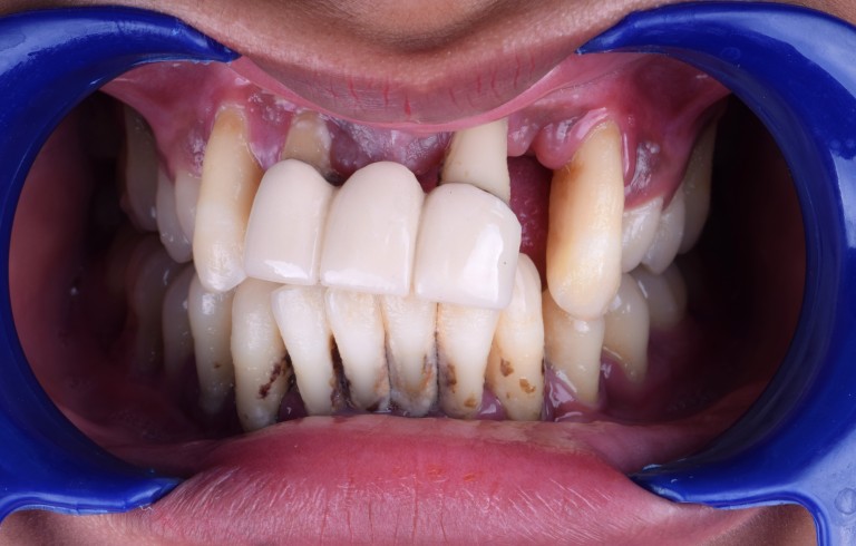 Full Mouth Inhabilitation