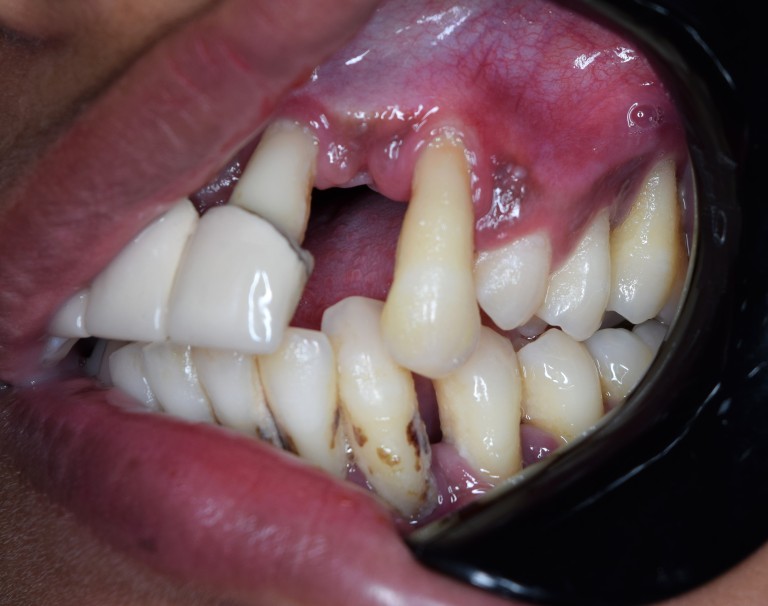 Full Mouth Inhabilitation