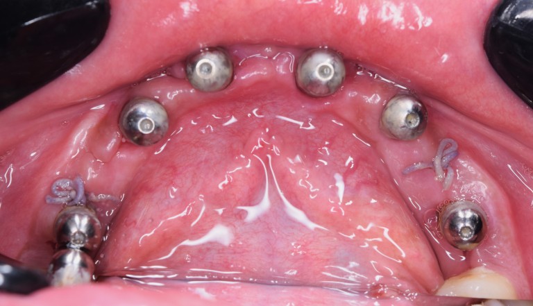 Full Mouth Inhabilitation