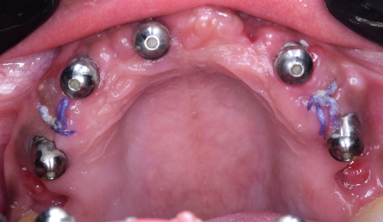 Full Mouth Inhabilitation