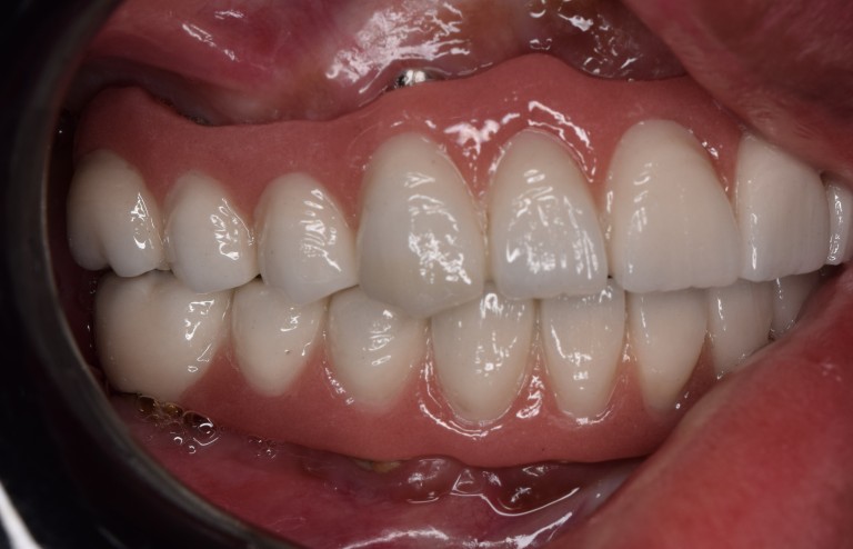 Full Mouth Inhabilitation