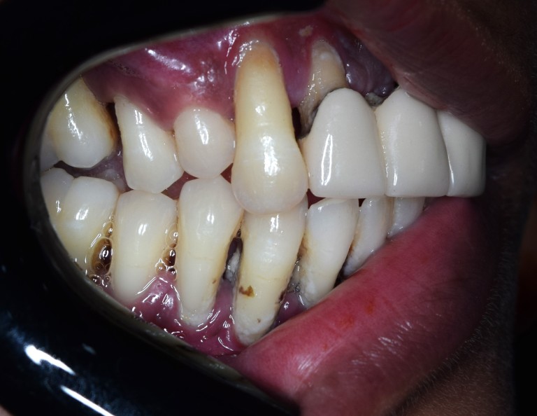 Full Mouth Inhabilitation