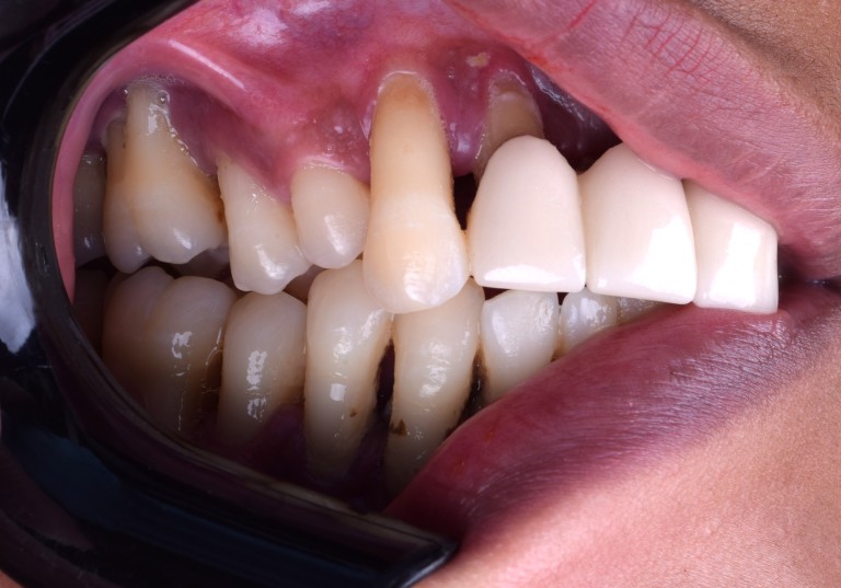 Full Mouth Inhabilitation
