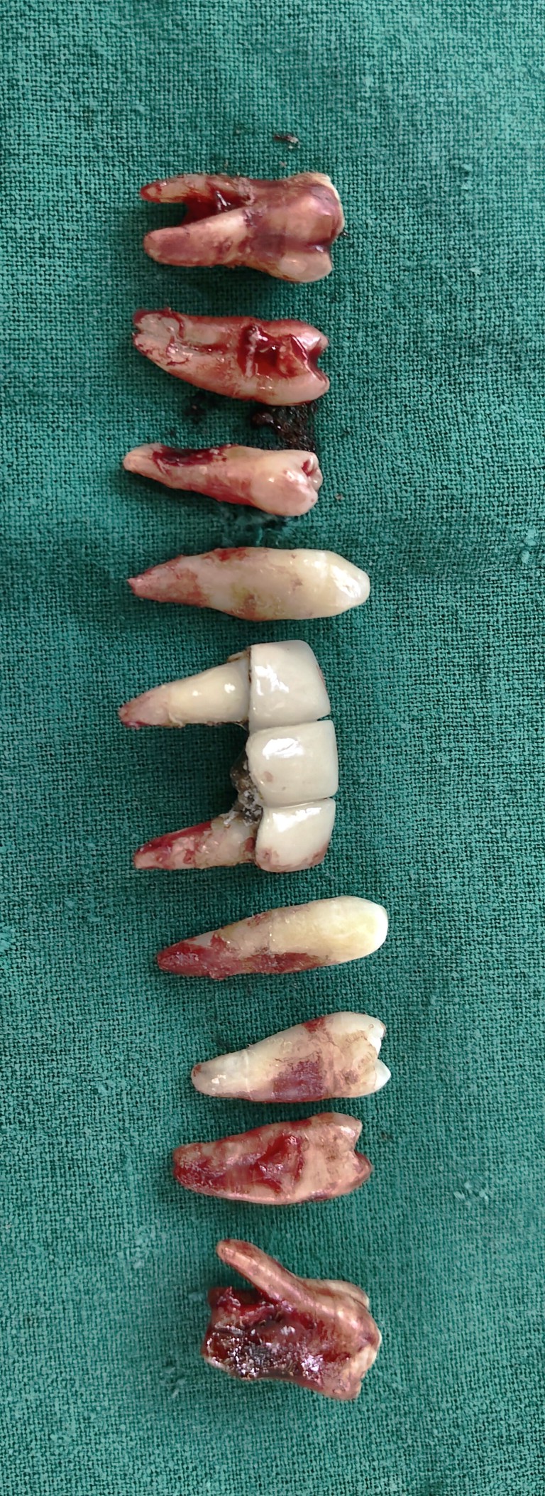 Full Mouth Inhabilitation