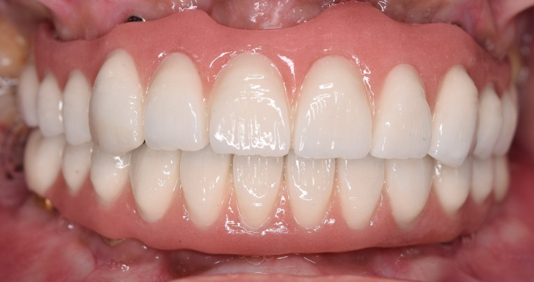 Full Mouth Inhabilitation
