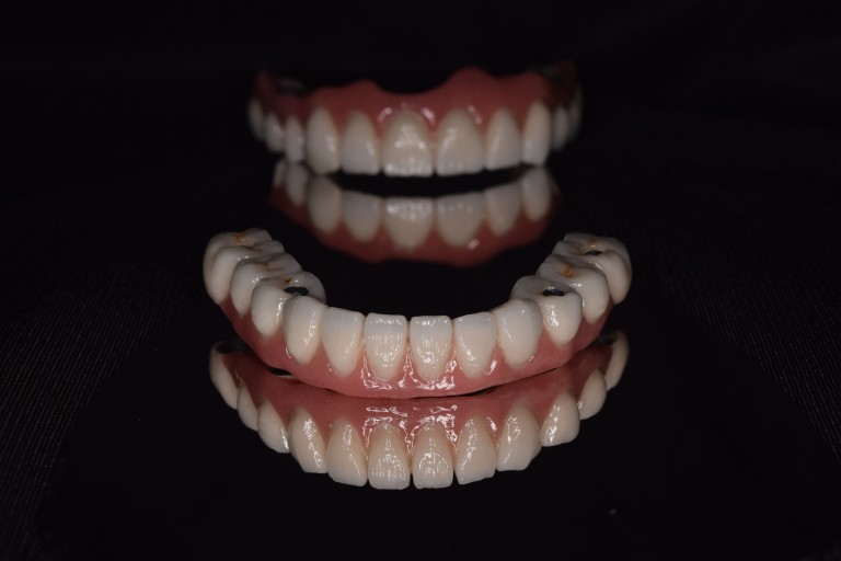 Full Mouth Inhabilitation