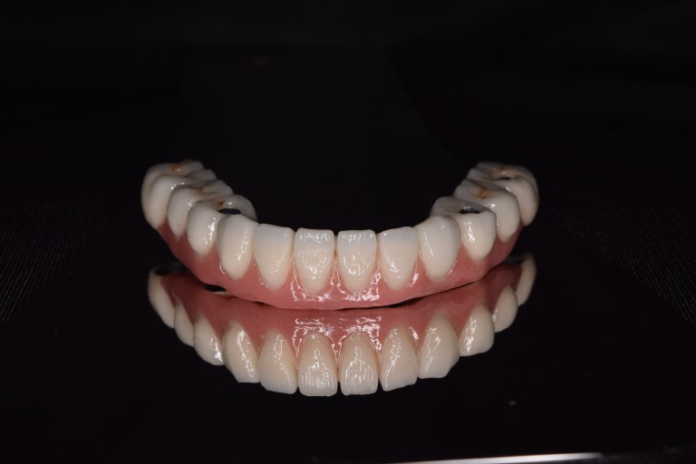 Full Mouth Inhabilitation