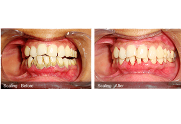 Scaling & Polishing