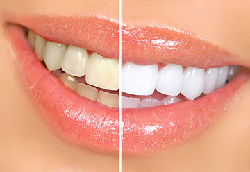 Tooth Whitening