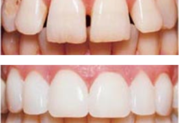 Veneers & Laminats